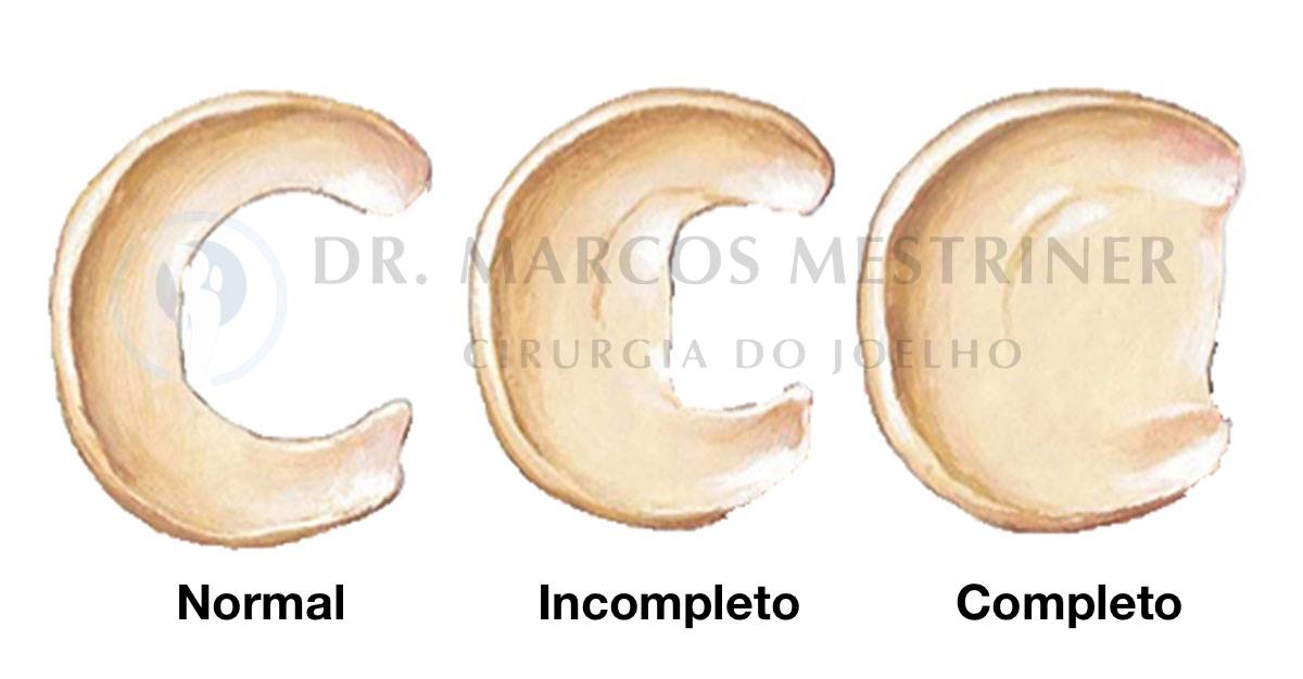 Les O De Menisco Como O Tratamento Dr Marcos Mestriner