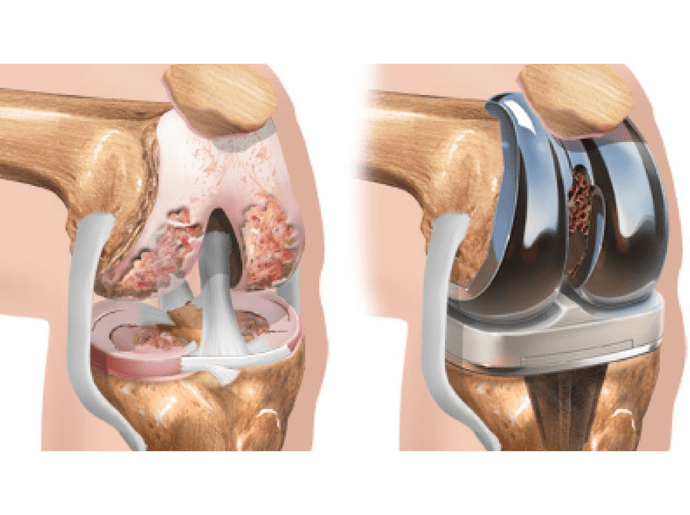 Artrose do joelho prótese artroplastia