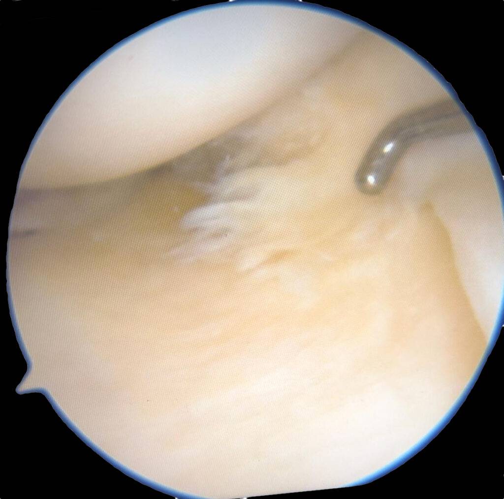 Artroscopia de joelho
Lesão de menisco