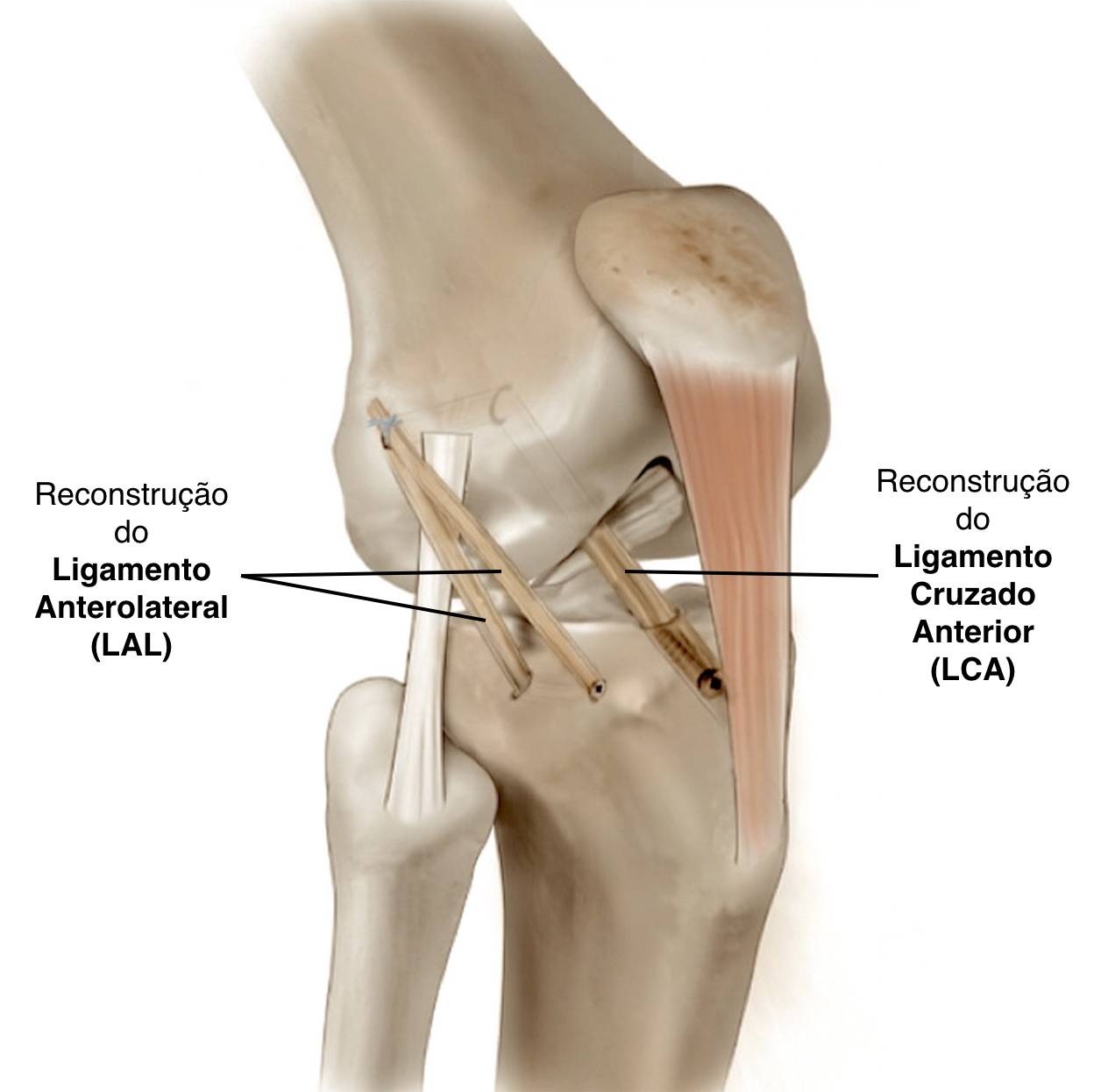 Reconstrução do Ligamento Cruzado Anterior
LCA
Reconstrução do Ligamento Anterolateral
LAL