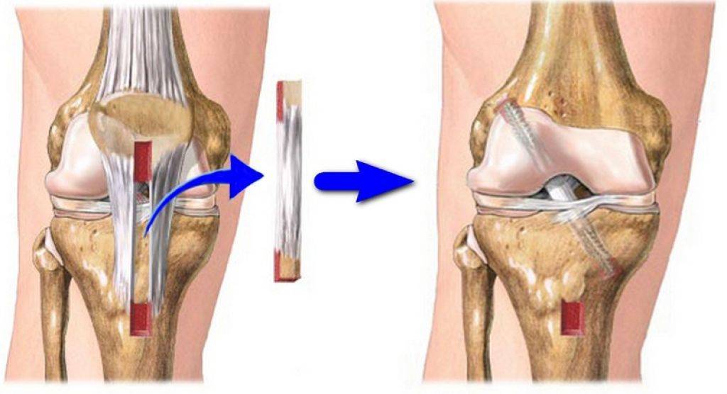 Reconstrução do ligamento cruzado anterior LCA Tendão patelar