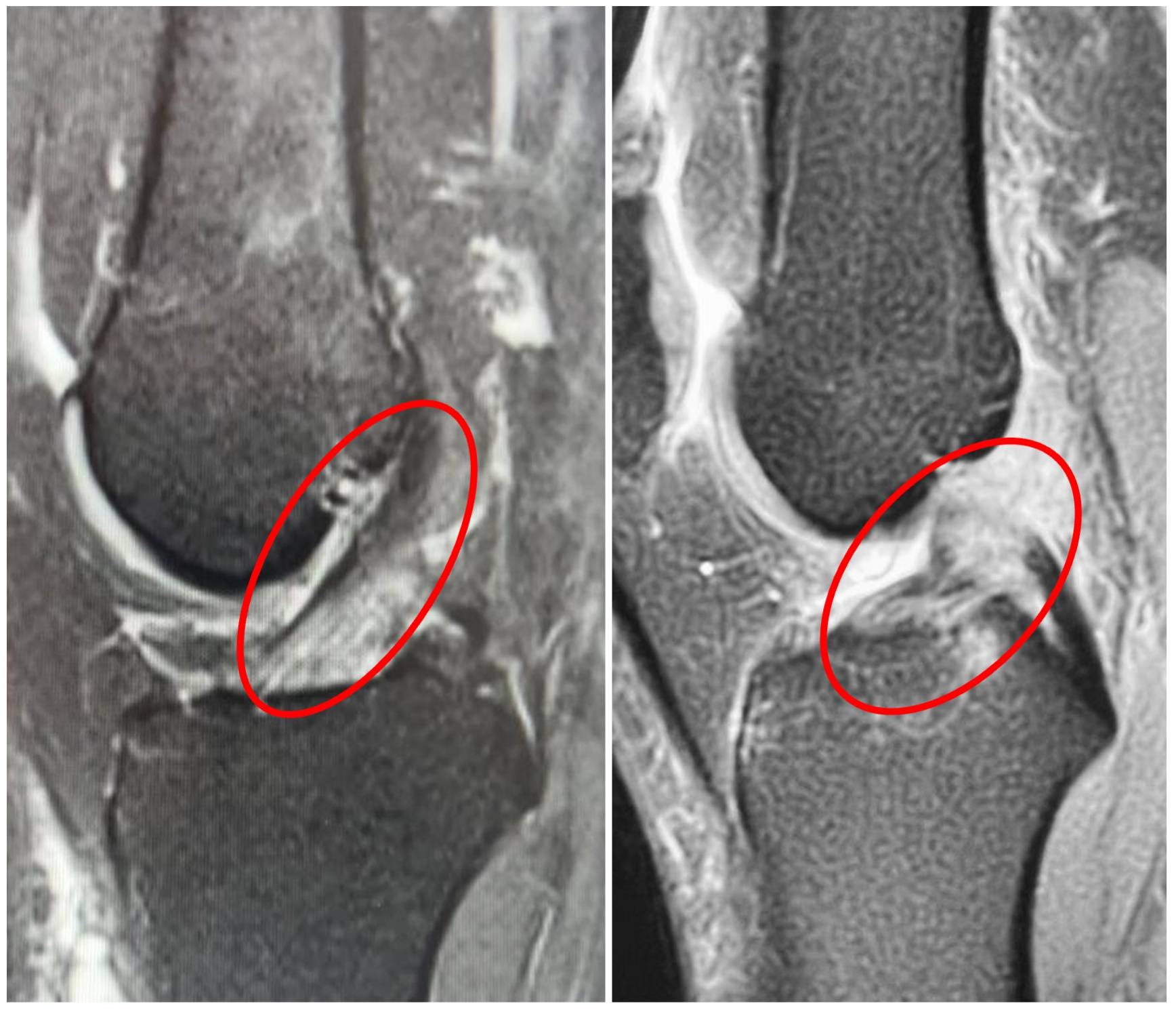 Lesão do ligamento cruzado anterior
Lesão do LCA
Ressonância
RNM