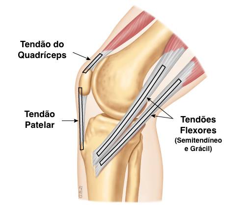 Lesão do ligamento cruzado anterior
LCA
Enxertos