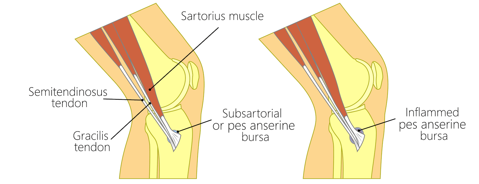 Bursite anserina