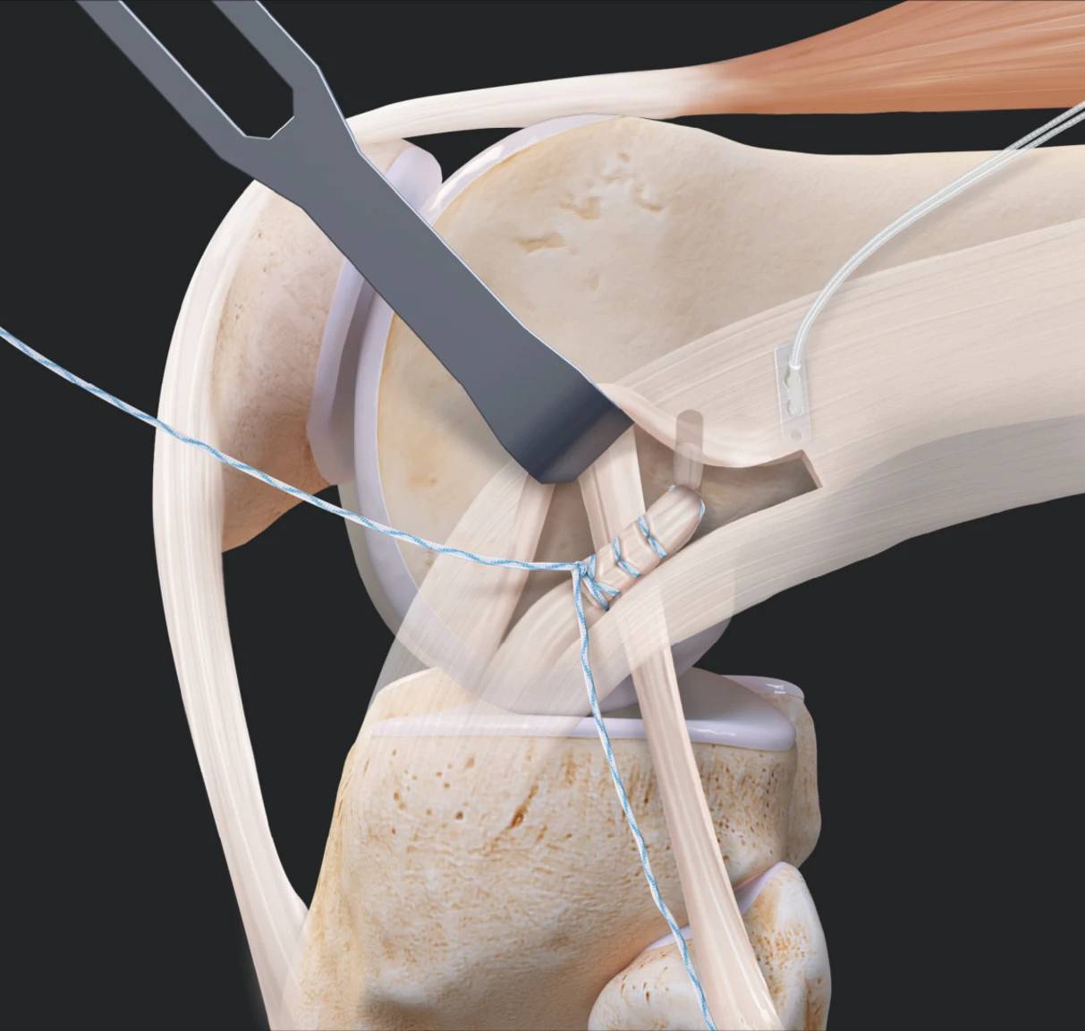 Reconstrução do ligamento cruzado anterior
LCA
Tenodese do trato iliotibial