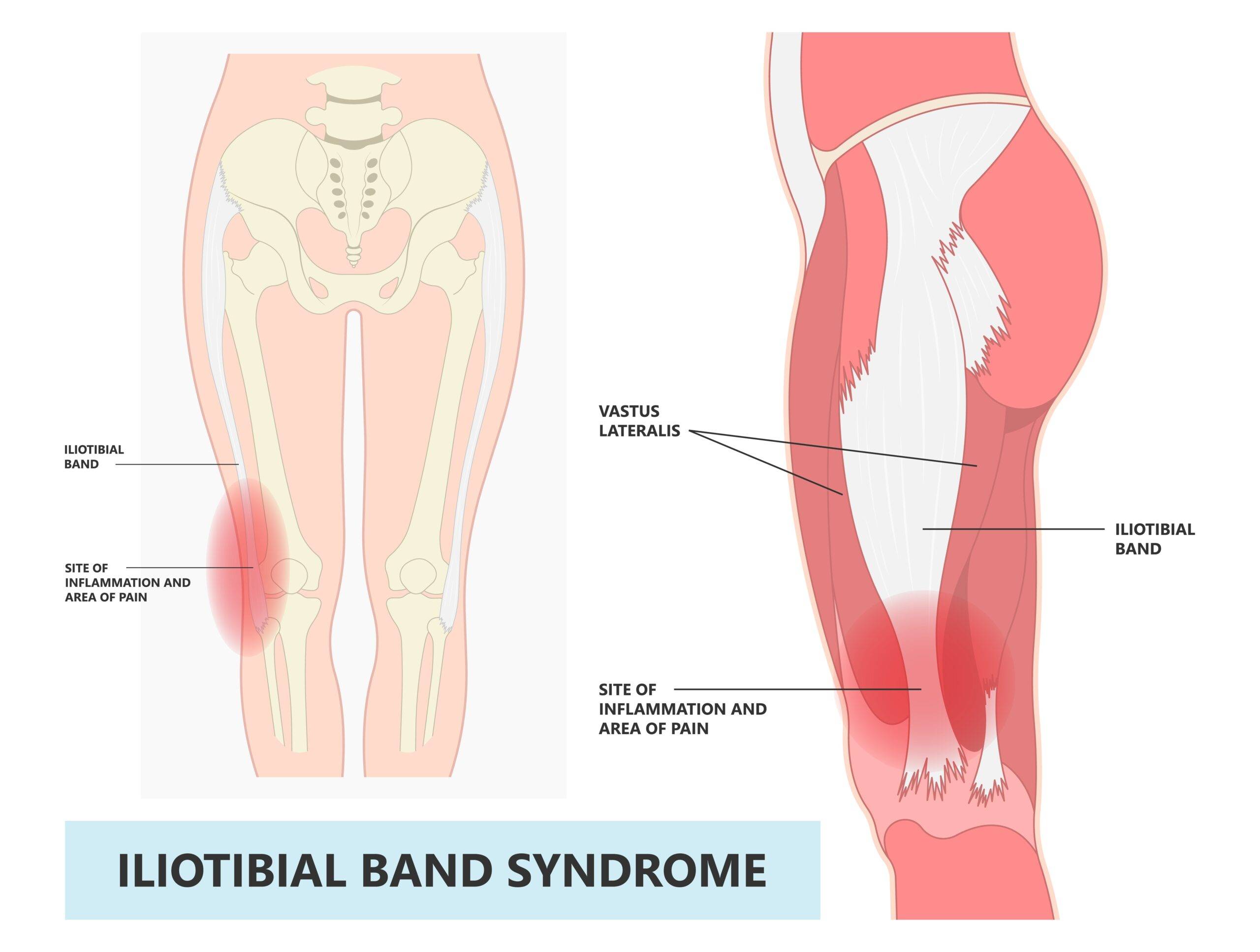 Síndrome da banda iliotibial