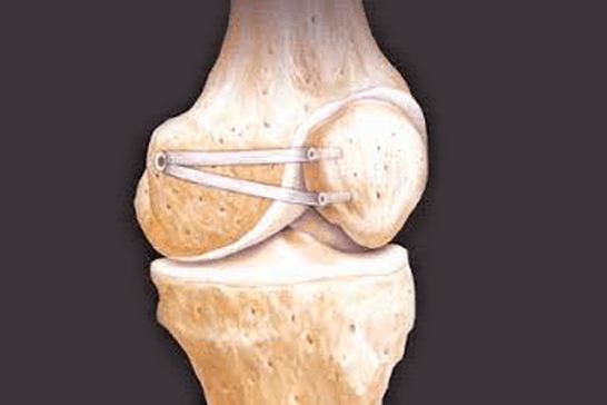 Ligamento patelo-femoral medial
LPFM
Luxação da patela
Instabilidade patelar