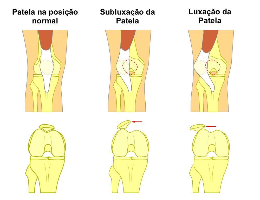 Luxação da Patela
Subluxação da Patela
Instabilidade Patelar