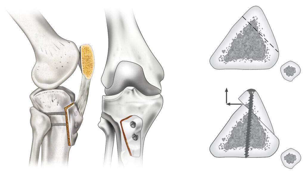 Osteotomia da TAT Fulkerson Instabilidade patelar Luxação da patela