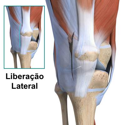 Liberação retinacular lateral
Luxação da patela
Instabilidade patelar