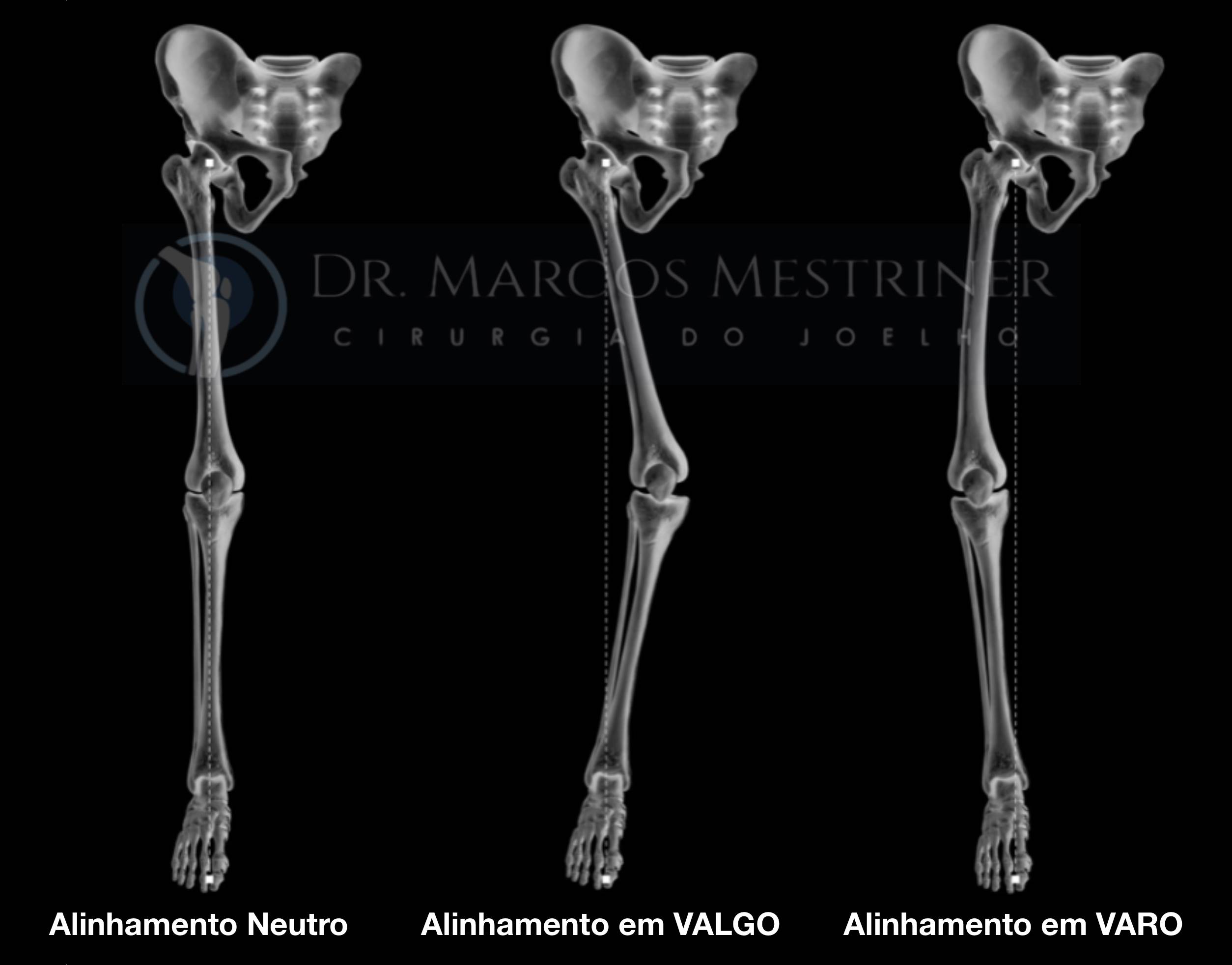 Alinhamento dos membros inferiores Radiografia panorâmica