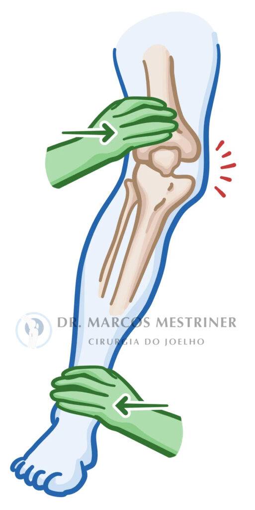 Lesão do ligamento colateral medial
LCM
Joelho