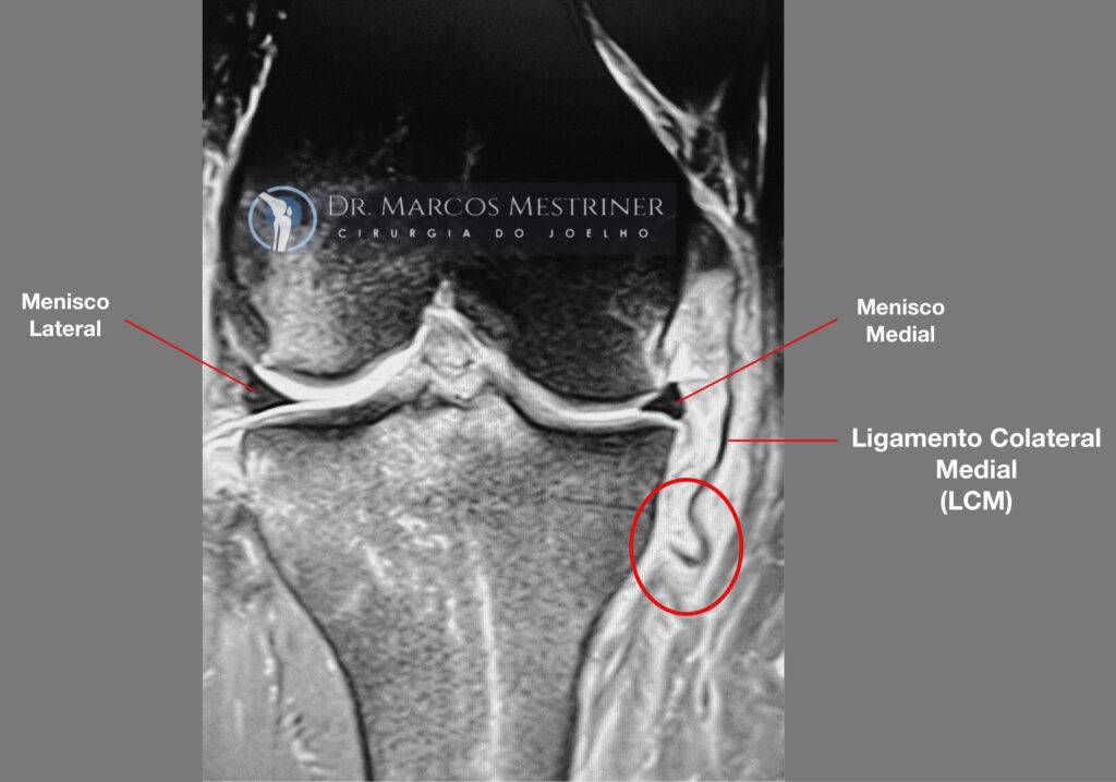 Lesão do ligamento colateral medial
LCM
Joelho
Ressonância