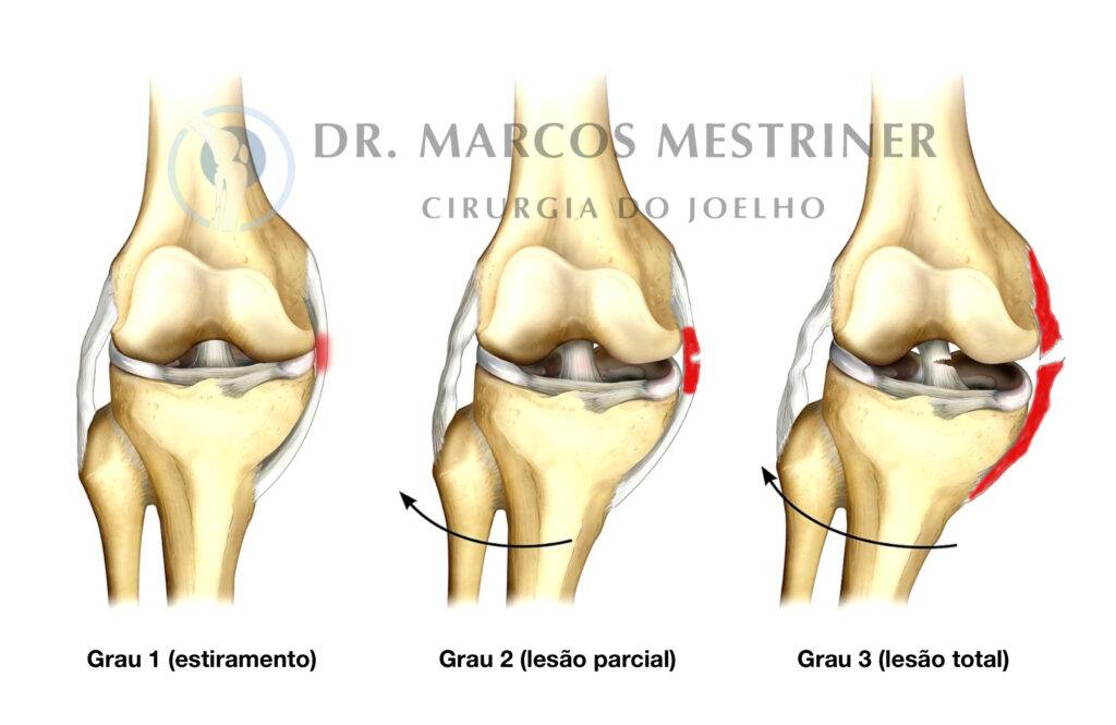 Lesão do ligamento colateral medial
LCM
Joelho