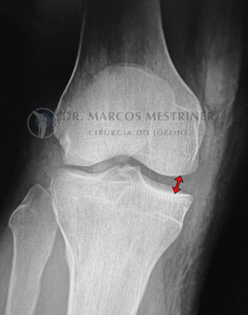 Lesão do ligamento colateral medial
LCM
Joelho
Radiografia