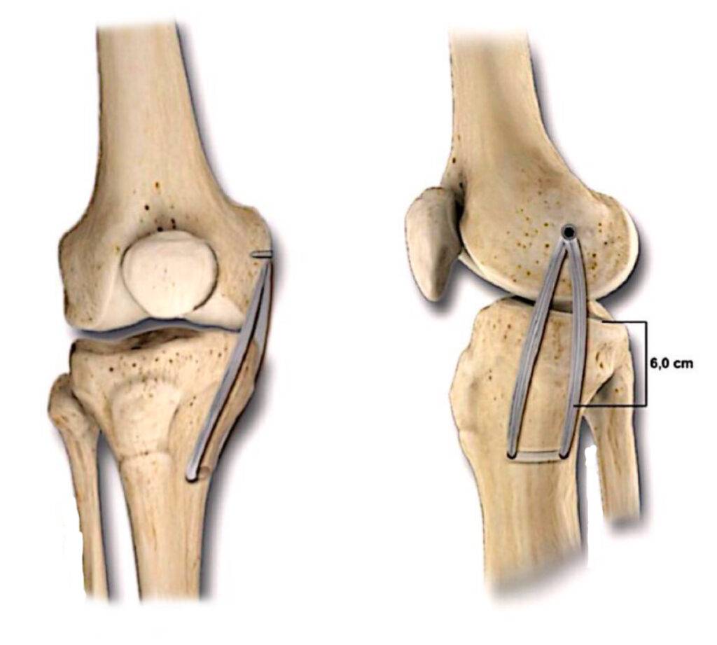 Lesão do ligamento colateral medial
LCM
Joelho
Cirurgia
Reconstrução