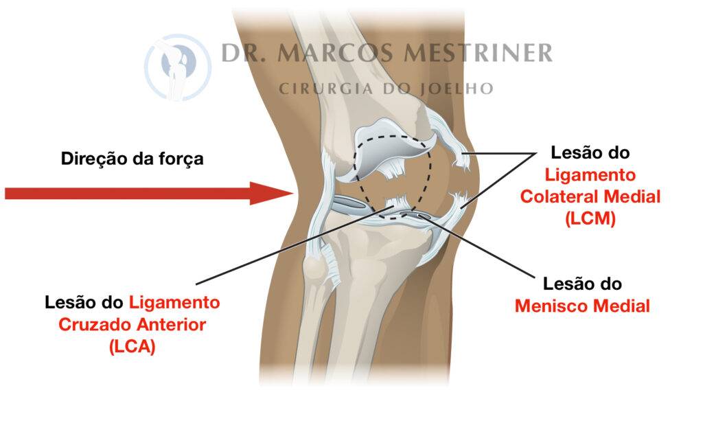 Lesão do ligamento colateral medial
LCM
LCA
Menisco medial
Tríade infeliz