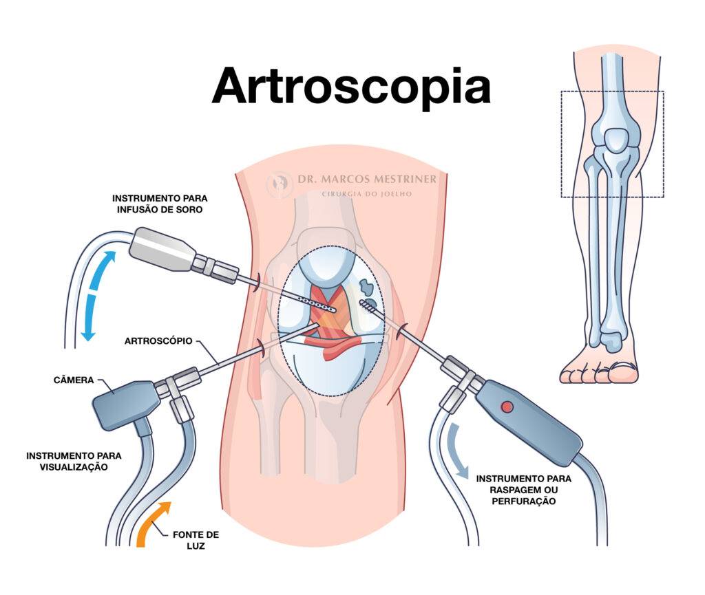 Joelho
Artroscopia
Lesão de ligamento
Lesão de menisco