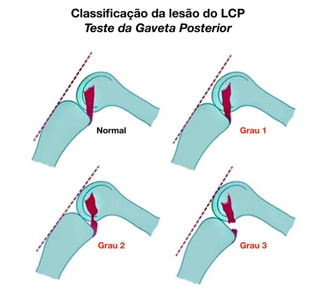 Lesão do ligamento cruzado posterior
LCP
Classificação
