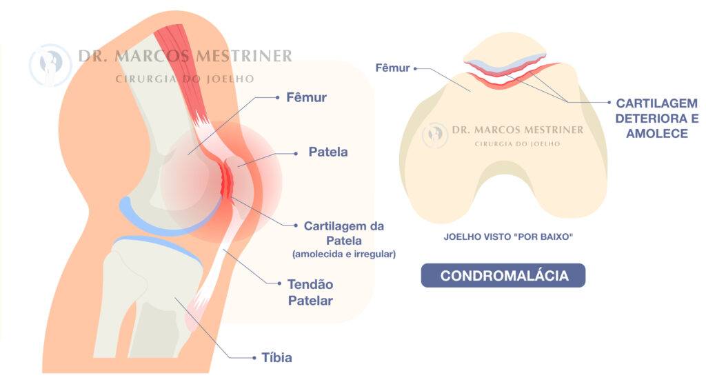 Dor no joelho
Condromalácia patelar
Condropatia patelar