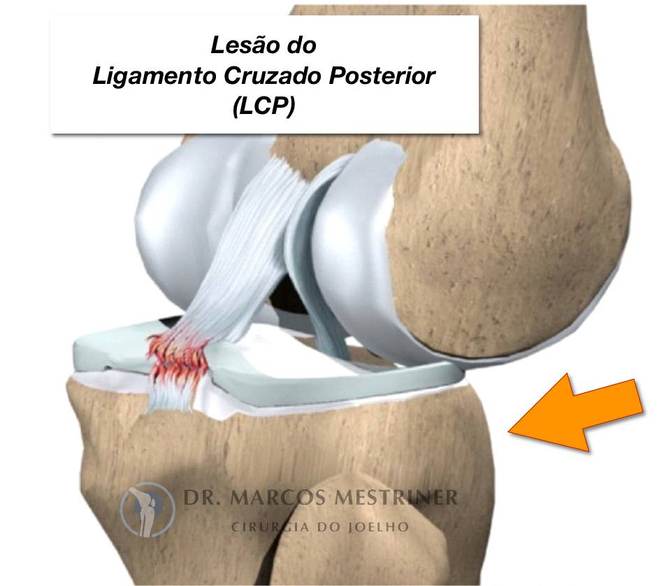 Lesão do ligamento cruzado posterior
LCP