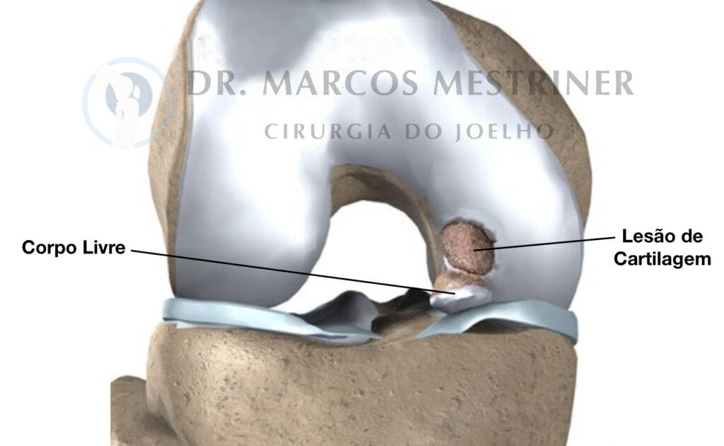 Lesão de cartilagem
Lesão osteocondral
Dor no joelho