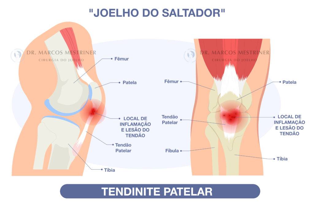 Tendinite patelar
Dor no joelho