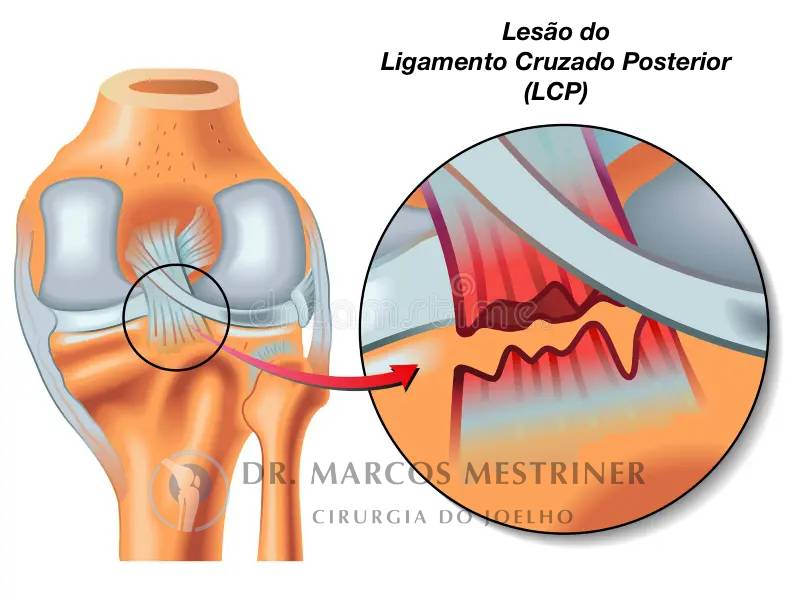 Lesão do ligamento cruzado posterior
LCP
