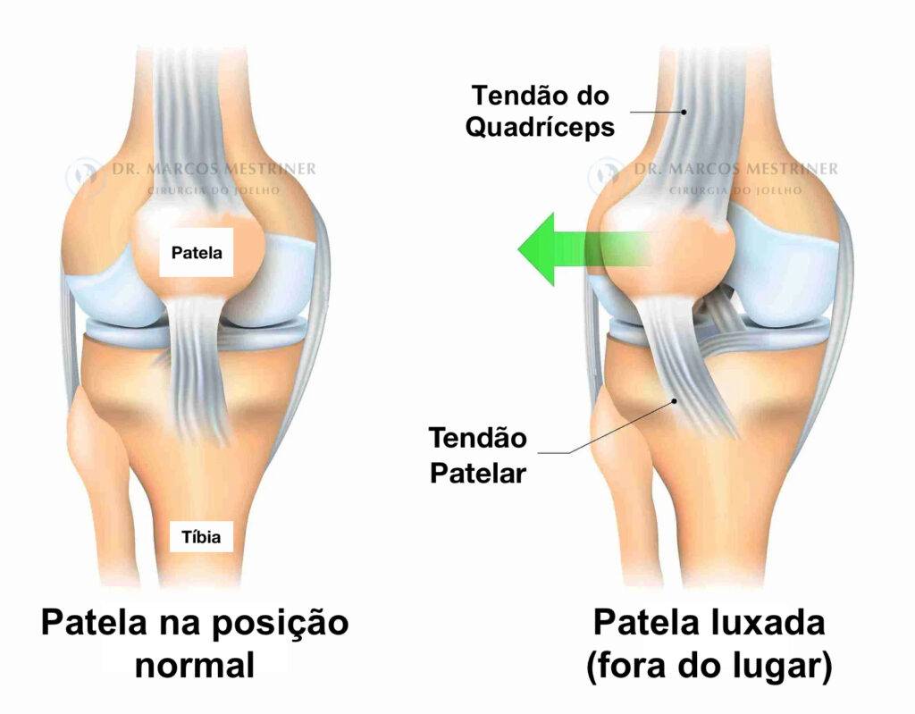 Instabilidade patelar
Luxação da patela
Dor no joelho