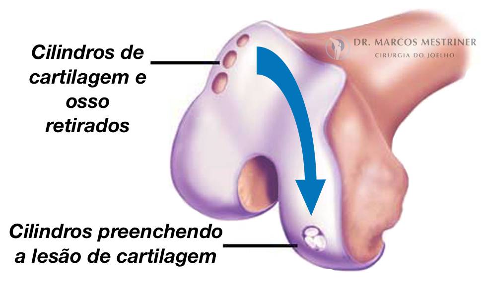 Lesão de cartilagem
Lesão osteocondral
Mosaicoplastia
Dor no joelho