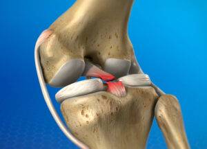 Lesão do ligamento cruzado posterior LCP