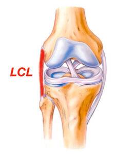 Ligamento Colateral Lateral LCL