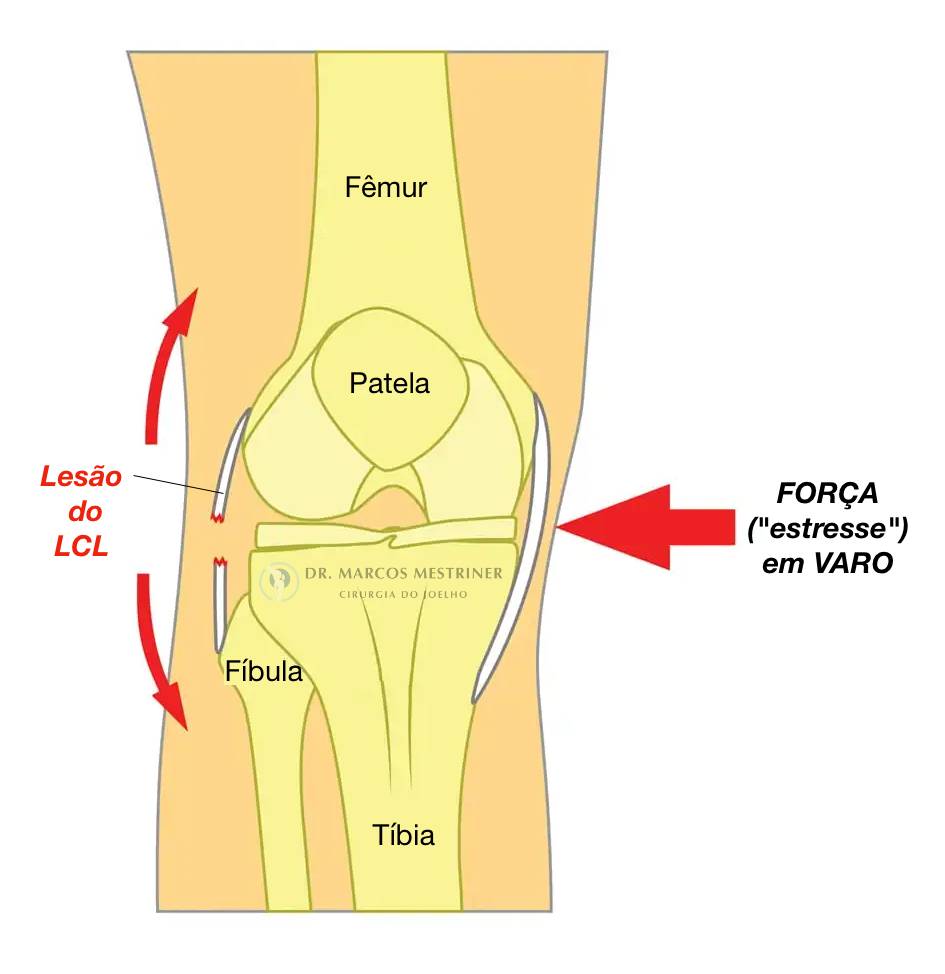 Lesão do ligamento colateral lateral
LCL