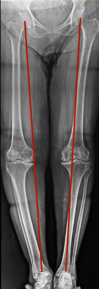 Lesão do ligamento colateral lateral
Lesão do canto póstero-lateral
LCL
CPL
Radiografia panorâmica