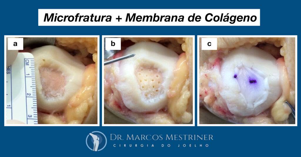 Lesão condral
Lesão osteocondral
Joelho
Cirurgia
Microfratura
Membrana de colágeno