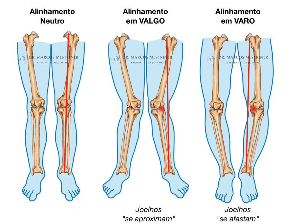 Alinhamento membros inferiores
Osteotomia