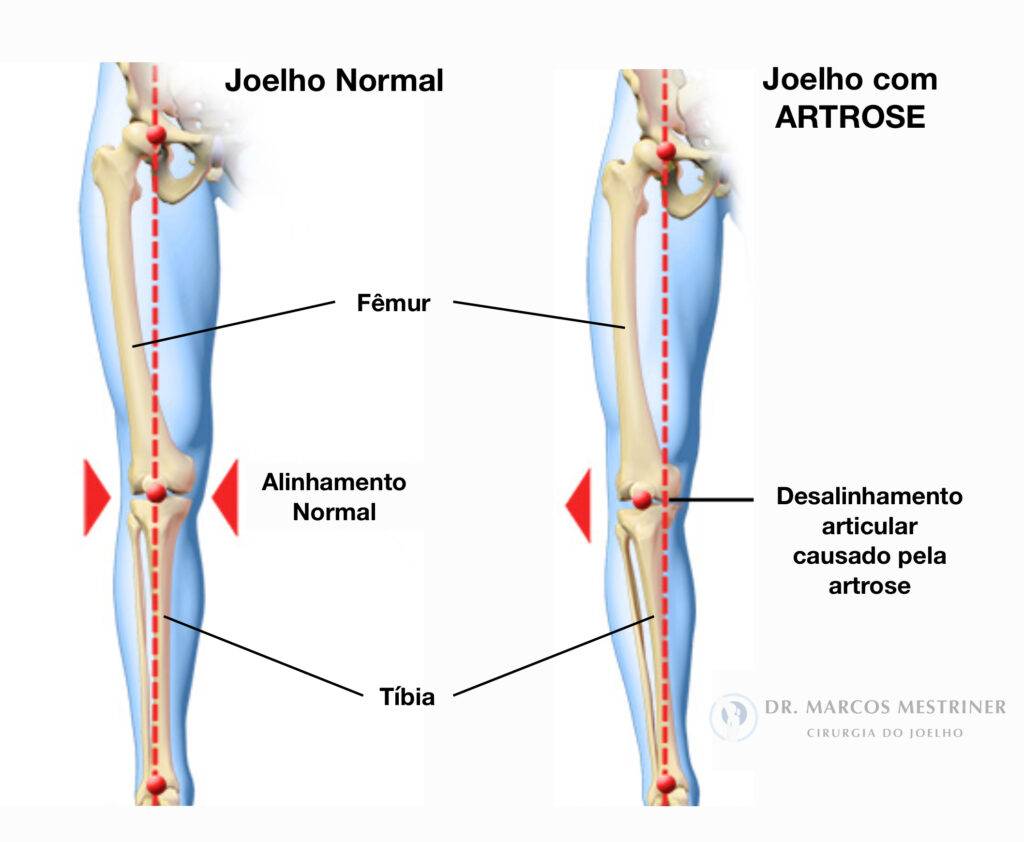 Alinhamento membros inferiores
Osteotomia
Fêmur
Tíbia