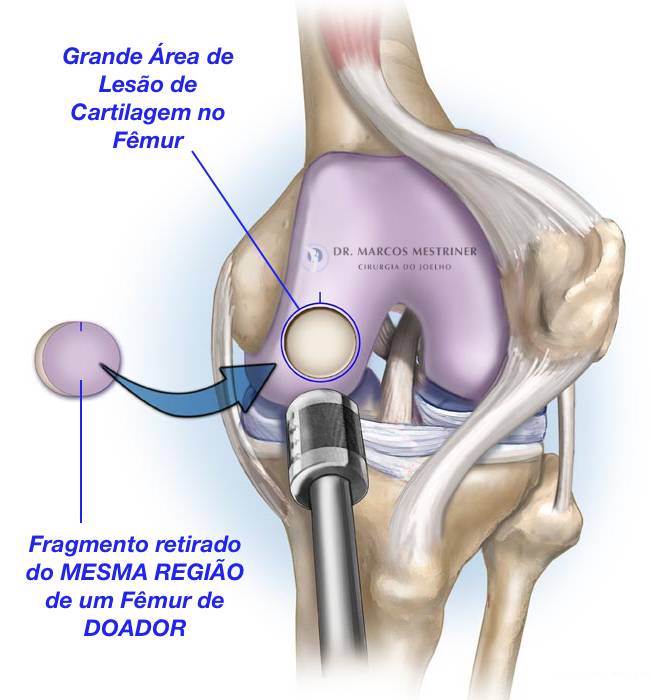 Lesão condral
Lesão osteocondral
Joelho
Cirurgia
Transplante Osteocondral Homólogo
OCA