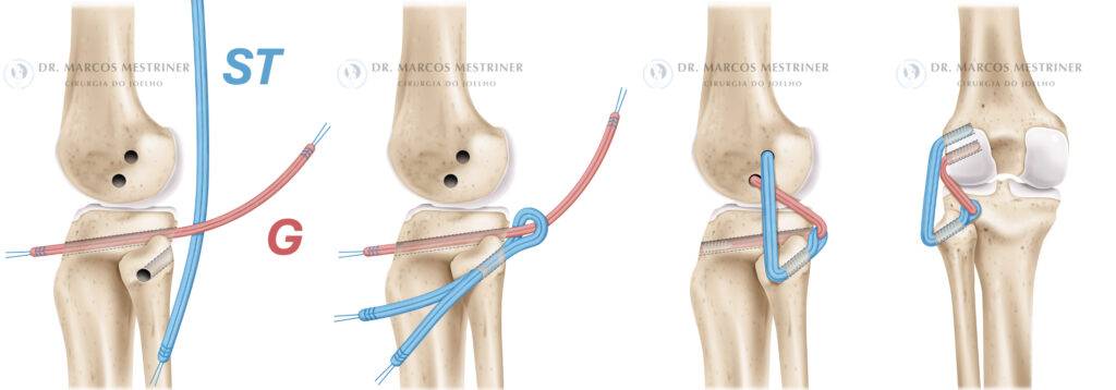 Lesão do ligamento colateral lateral
Lesão do canto póstero-lateral
LCL
CPL
Tratamento cirúrgico
Reconstrução