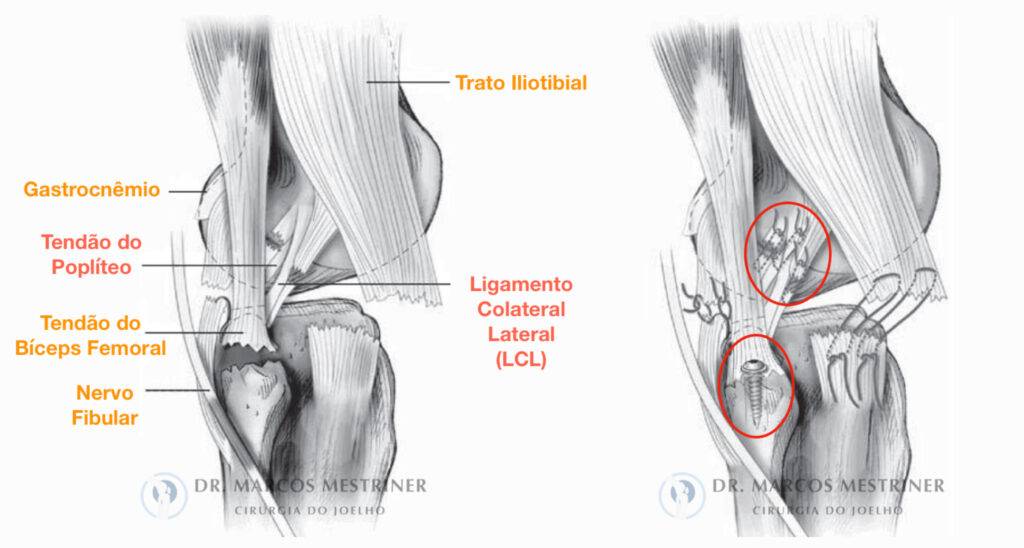 Lesão do ligamento colateral lateral
Lesão do canto póstero-lateral
LCL
CPL
Tratamento cirúrgico
Reparo