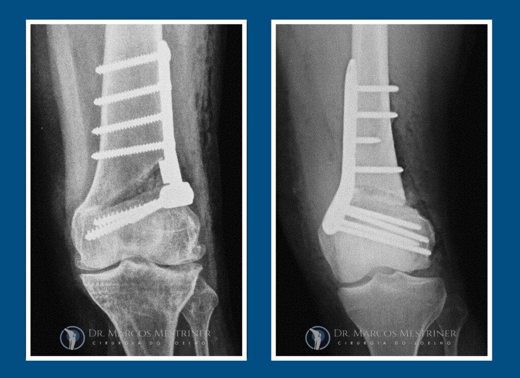 Alinhamento membros inferiores
Artrose
Osteotomia
Fêmur