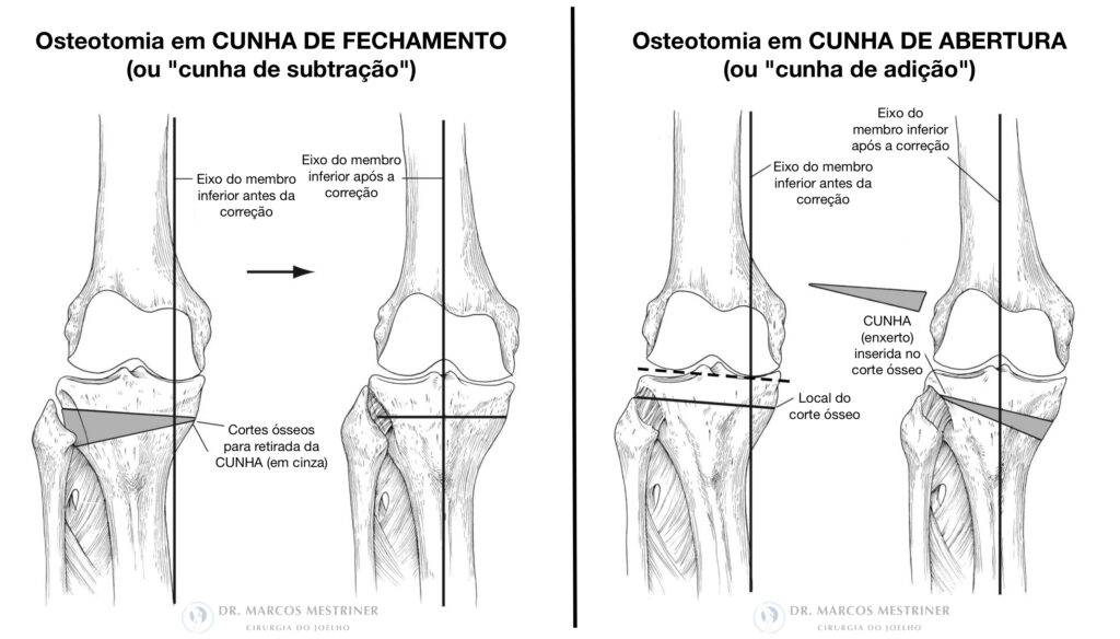 Alinhamento membros inferiores
Artrose
Osteotomia
Tíbia