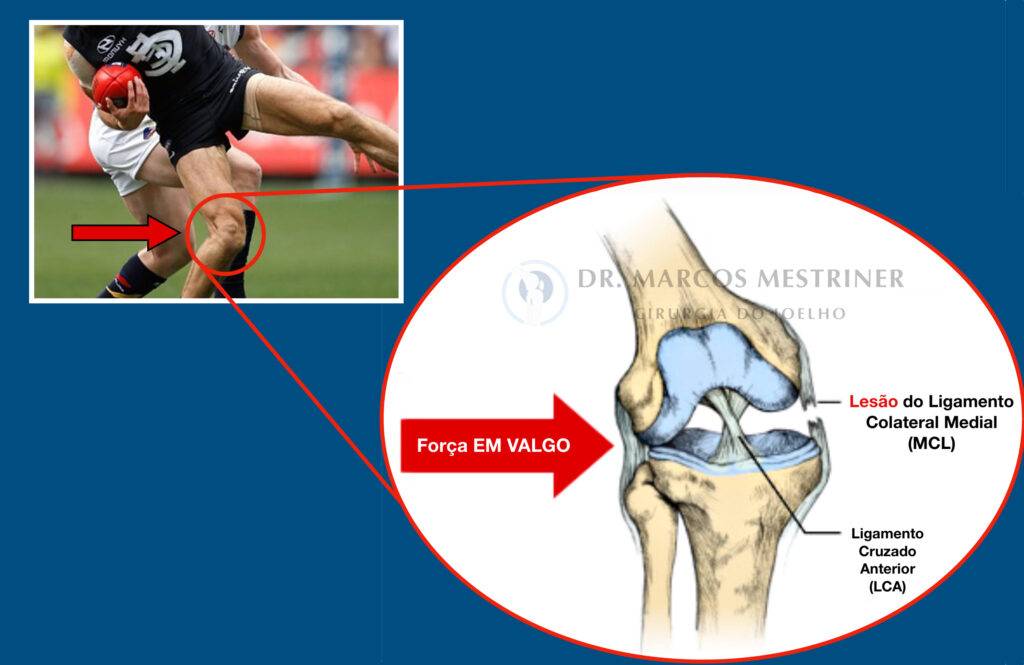 Lesão do ligamento colateral medial
LCM
Joelho
Esporte