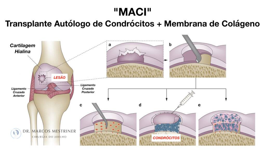 Lesão condral
Lesão osteocondral
Joelho
Cirurgia
Transplante autólogo de condrócitos
Membrana de colágeno