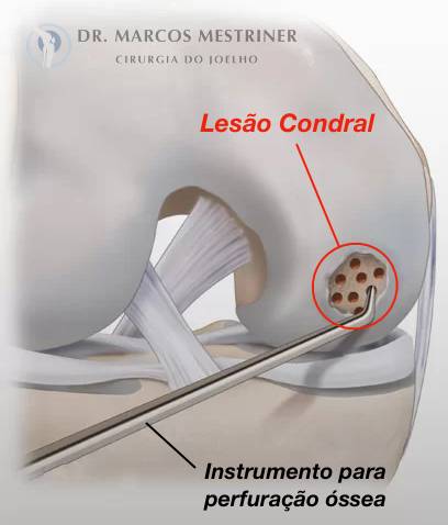 Lesão condral
Lesão osteocondral
Joelho
Cirurgia
Microfratura