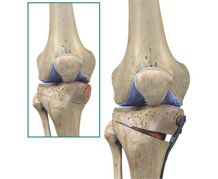 Lesão do ligamento colateral lateral
Lesão do canto póstero-lateral
LCL
CPL
Tratamento cirúrgico
Osteotomia