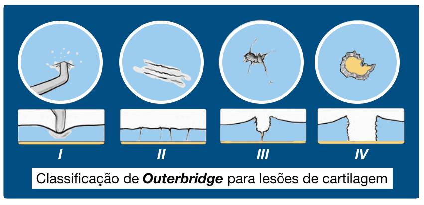 Lesão condral
Lesão osteocondral
Joelho
Classificação
Outerbridge