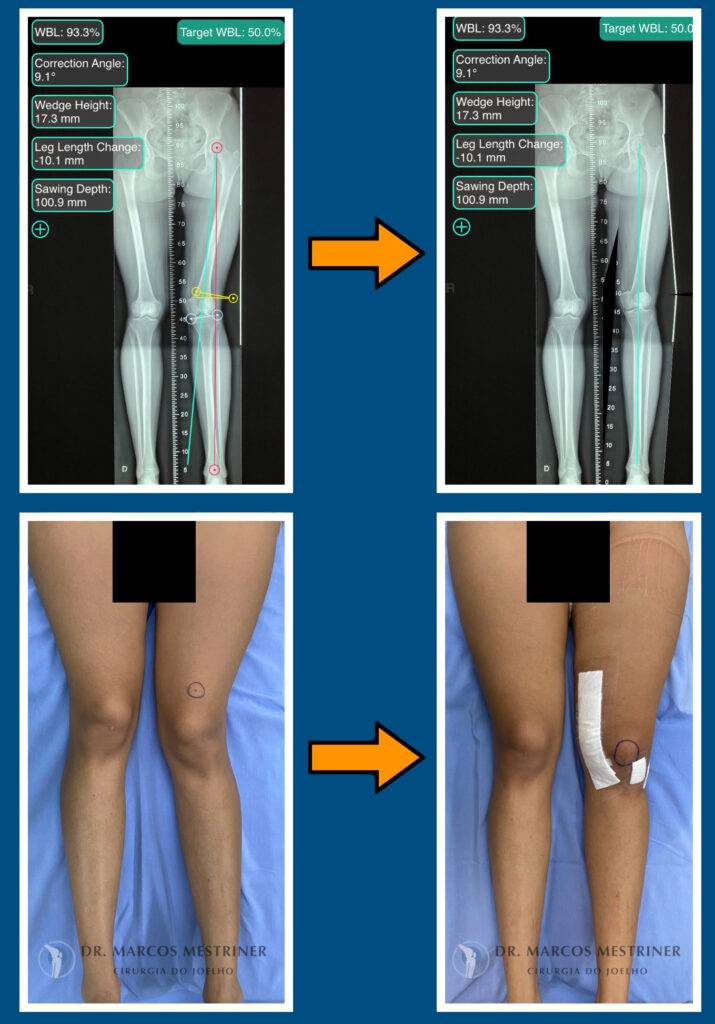 Alinhamento membros inferiores
Artrose
Osteotomia
Fêmur
Planejamento