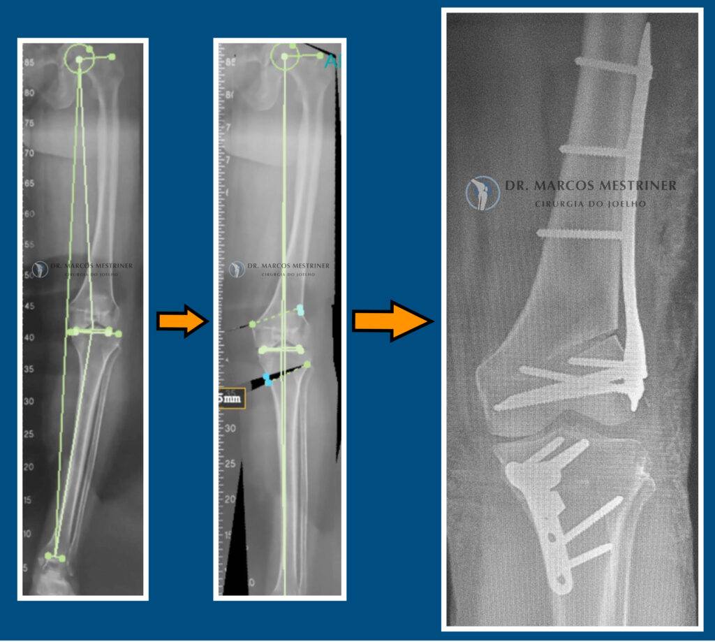 Alinhamento membros inferiores
Artrose
Dupla Osteotomia
Fêmur
Tíbia
Planejamento
