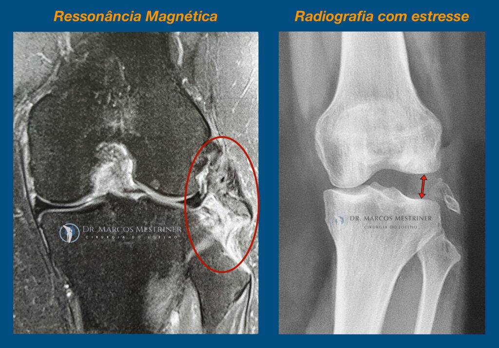 Lesão do ligamento colateral lateral
Lesão do canto póstero-lateral
LCL
CPL
Ressonância magnética
Radiografia com estresse